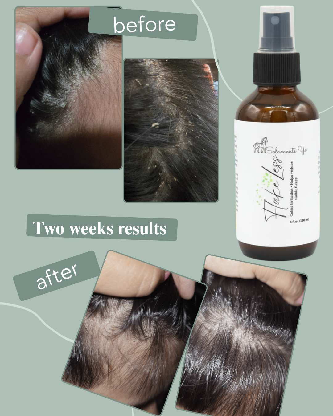 FlakeLess Scalp Mist -Gentle Relief for Dry, Itchy, or Flaky Scalp