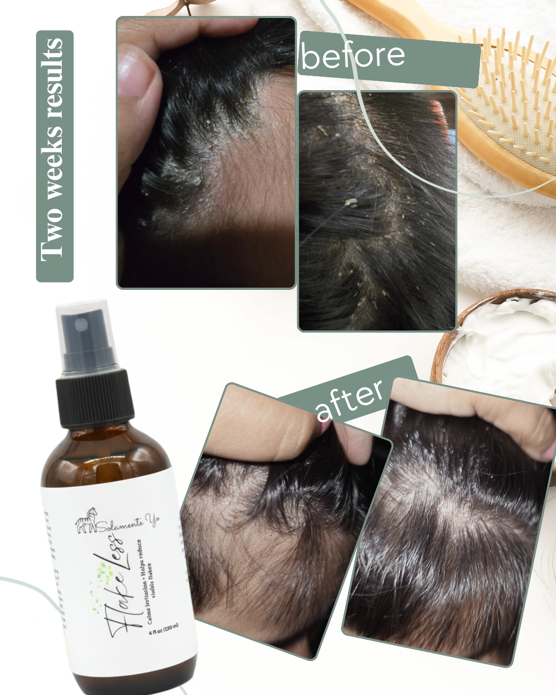 FlakeLess Scalp Mist -Gentle Relief for Dry, Itchy, or Flaky Scalp